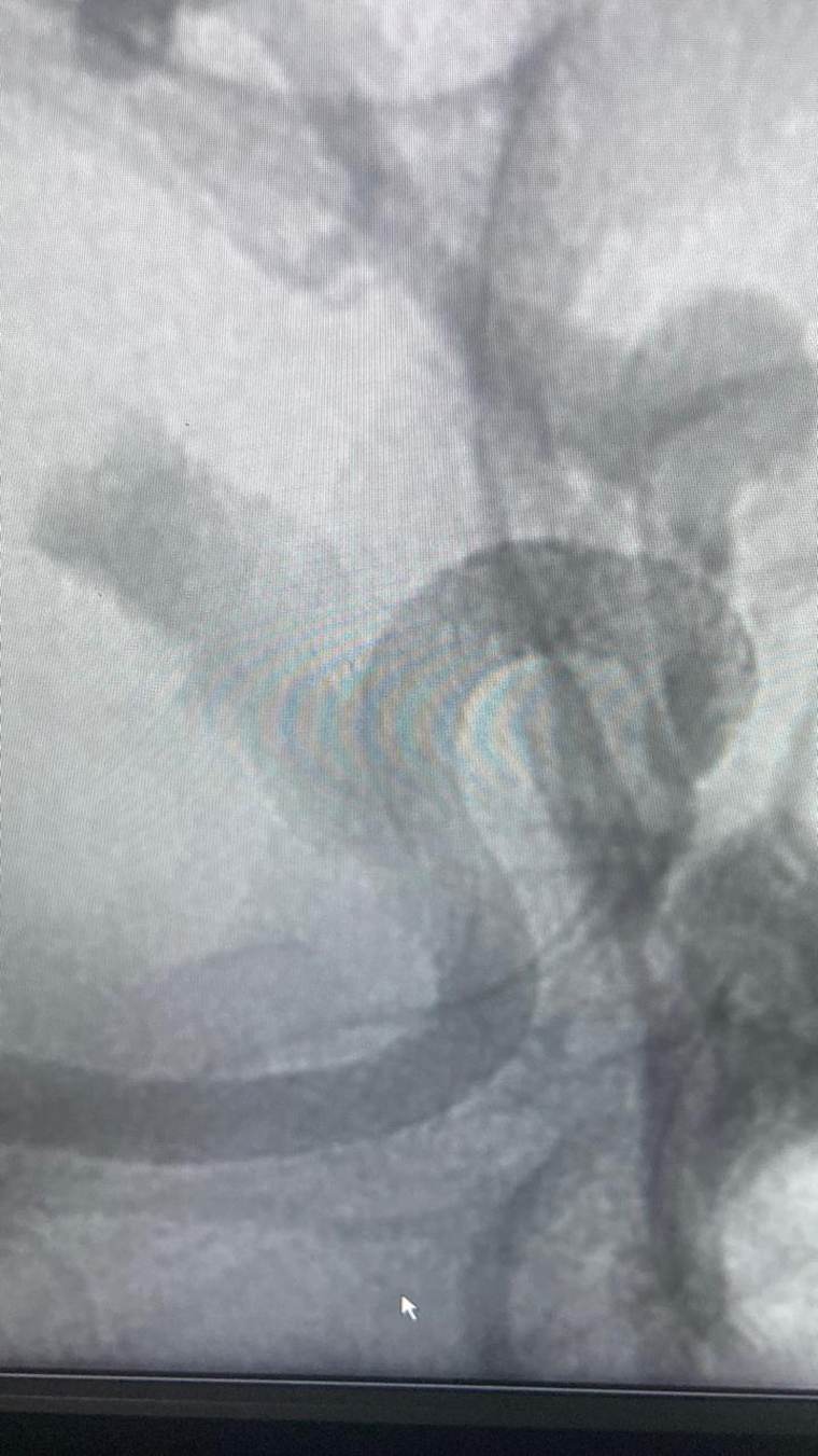 Post-procedure imaging — Expert-Led Neurovascular Intervention at Shalby Hospital